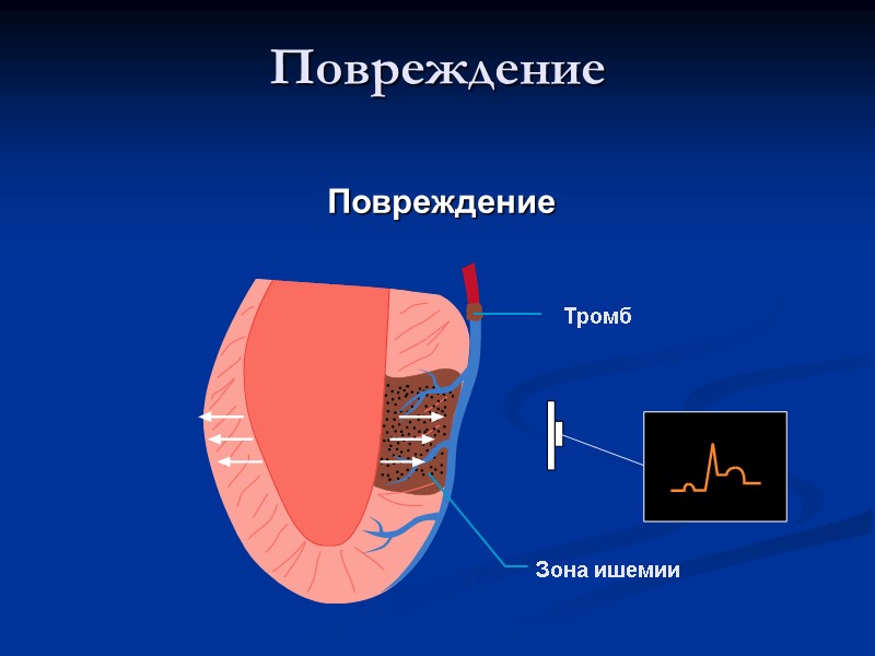 Повреждение Тромб Зона ишемии Повреждение